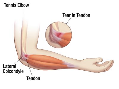 بیماری آرنج تنیسبازان tennis elbow